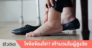 อาการเท้าบวม ในผู้สูงอายุ-เท้า-ผู้สูงอายุ-การดูแลผู้สูงอายุ-อาการบวม