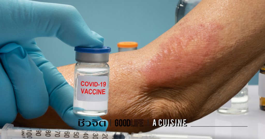 โรคโควิด-19 กับอาการทางผิวหนัง ผื่น โควิด-19 โควิด วัคซีนโควิด 